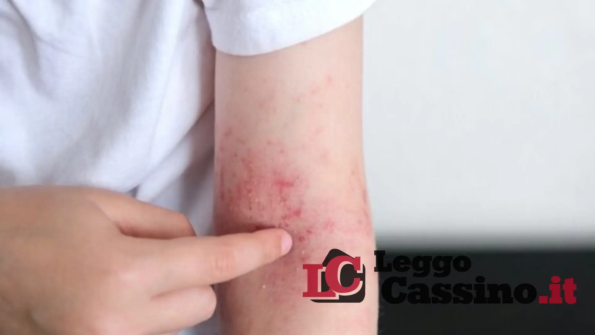 Ancora un caso di scabbia nel cassinate: sale la paura